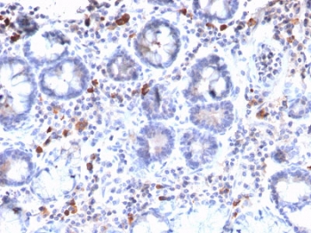 IHC staining of FFPE human gastric carcinoma with MUC3 antibody. HIER: boil tissue sections in 10mM Tris with 1mM EDTA, pH 9, for 10-20 min and allow to cool before testing.~
