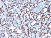 IHC staining of FFPE human angiocarcinoma with recombinant CD31 antibody (clone C31/2876R). Required HIER: boil tissue sections in 10mM Tris with 1mM EDTA, pH9, for 10-20 min followed by cooling at RT for 20 min.