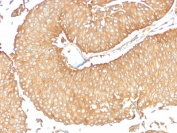 IHC testing of FFPE human ovarian carcinoma with Calcineurin antibody (clone CALNA/2353). HIER: boil tissue sections in pH6, 10mM citrate buffer, for 10-20 min followed by cooling at RT for 20 min.
