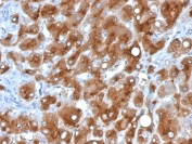 IHC staining of FFPE human hepatocellular carcinoma with SAA antibody (clone SAA/326). HIER: boil tissue sections in 10mM Tris with 1mM EDTA, pH 9, for 10-20 min and allow to cool before testing.