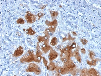 IHC staining of FFPE human hepatocellular carcinoma with SAA antibody. HIER: boil tissue sections in 10mM Tris with 1mM EDTA, pH 9, for 10-20 min and allow to cool before testing.~