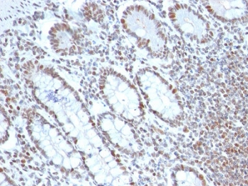 IHC testing of FFPE human colon carcinoma with BMI-1 antibody (clone BMI1/2689). HIER: boil tissue sections in pH6, 10mM citrate buffer, for 10-20 min followed by cooling at RT for 20 min.~