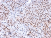 IHC staining of FFPE human colon carcinoma with phospho-RNA polymerase II antibody (clone CTD 8A7). HIER: boil tissue sections in pH6, 10mM citrate buffer, for 10-20 min and allow to cool before testing.