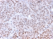 IHC staining of FFPE human colon carcinoma with phospho-RNA polymerase II antibody (clone CTD 8A7). HIER: boil tissue sections in pH6, 10mM citrate buffer, for 10-20 min and allow to cool before testing.