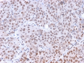 IHC staining of FFPE human colon carcinoma with phospho-RNA polymerase II antibody (clone CTD 8A7). HIER: boil tissue sections in pH6, 10mM citrate buffer, for 10-20 min and allow to cool before testing.~