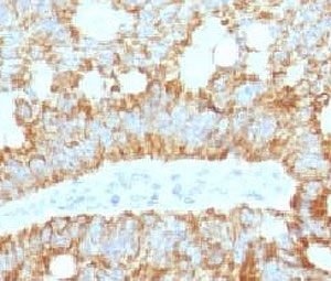 IHC staining of FFPE human colon carcinoma with ICOS Ligand antibody (clone ISLG-1). HIER: boil tissue sections in pH 9 10mM Tris with 1mM EDTA for 10-20 min and allow to cool before testing.~