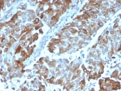 IHC staining of FFPE human renal cell carcinoma with OX40 antibody (clone OX40/3108). HIER: boil tissue sections in pH6, 10mM citrate buffer, for 10-20 min and allow to cool before testing.