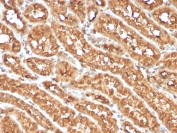 IHC staining of FFPE human renal cell carcinoma with OX40 antibody (clone OX40/3108). HIER: boil tissue sections in pH6, 10mM citrate buffer, for 10-20 min and allow to cool before testing.