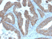 IHC staining of FFPE human prostate carcinoma with CD47 antibody (clone CD47/3019). HIER: boil tissue sections in pH 9 10mM Tris with 1mM EDTA for 10-20 min and allow to cool before testing.