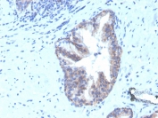 IHC staining of FFPE human prostate carcinoma with biotinylated CD47 antibody (clone CD47/3019). HIER: boil tissue sections in pH 9 10mM Tris with 1mM EDTA for 10-20 min and allow to cool before testing.