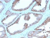 IHC staining of FFPE human prostate carcinoma with CD47 antibody (clone CD47/2937). HIER: boil tissue sections in pH 9 10mM Tris with 1mM EDTA for 10-20 min and allow to cool before testing.