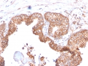 IHC staining of FFPE human prostate carcinoma with CD47 antibody (clone CD47/2937). HIER: boil tissue sections in pH 9 10mM Tris with 1mM EDTA for 10-20 min and allow to cool before testing.