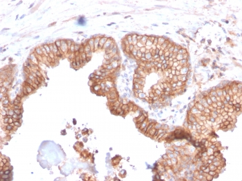 IHC staining of FFPE human prostate carcinoma with CD47 antibody (clone CD47/2937). HIER: boil tissue sections in pH 9 10mM Tris with 1mM EDTA for 10-20 min and allow to cool before testing.~