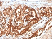 IHC staining of FFPE human prostate carcinoma with biotinylated CD47 antibody (clone CD47/2937). HIER: boil tissue sections in pH 9 10mM Tris with 1mM EDTA for 10-20 min and allow to cool before testing.
