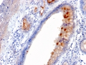 IHC testing of FFPE human gastric carcinoma with MUC4 antibody (clone MUC4/3084). HIER: requires steaming of sections in pH 9 10mM Tris with 1mM EDTA for 10-20 min and allow to cool before testing.