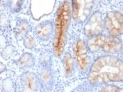 IHC testing of FFPE human gastric carcinoma with MUC4 antibody (clone MUC4/3084). HIER: requires steaming of sections in pH 9 10mM Tris with 1mM EDTA for 10-20 min and allow to cool before testing.