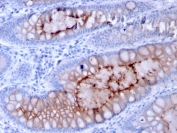 IHC testing of FFPE human colon carcinoma with MUC4 antibody (clone MUC4/3084). HIER: requires steaming of sections in pH 9 10mM Tris with 1mM EDTA for 10-20 min and allow to cool before testing.