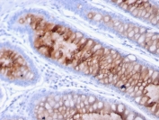 IHC testing of FFPE human colon carcinoma with MUC4 antibody (clone MUC4/3105). HIER: requires steaming of sections in 10mM citrate buffer, pH 6, for 10-20 min and allow to cool before testing.