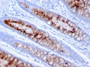 IHC testing of FFPE human colon carcinoma with MUC4 antibody (clone MUC4/3105). HIER: requires steaming of sections in 10mM citrate buffer, pH 6, for 10-20 min and allow to cool before testing.