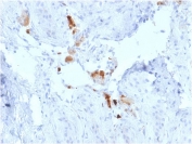 IHC testing of FFPE human testicular carcinoma with Calbindin 2 antibody (clone CALB2/2786). HIER: boil tissue sections in pH 9 10mM Tris with 1mM EDTA for 10-20 min followed by cooling at RT for 20 min.