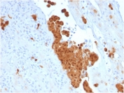IHC testing of FFPE human mesothelioma with Calbindin 2 antibody (clone CALB2/2786). HIER: boil tissue sections in pH 9 10mM Tris with 1mM EDTA for 10-20 min followed by cooling at RT for 20 min.