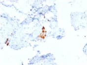 IHC testing of FFPE human testicular carcinoma with Calbindin 2 antibody (clone CALB2/2807). HIER: boil tissue sections in pH 9 10mM Tris with 1mM EDTA for 10-20 min followed by cooling at RT for 20 min.