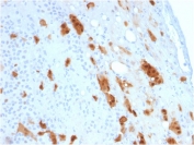 IHC testing of FFPE human mesothelioma with Calbindin 2 antibody (clone CALB2/2807). HIER: boil tissue sections in pH 9 10mM Tris with 1mM EDTA for 10-20 min followed by cooling at RT for 20 min.