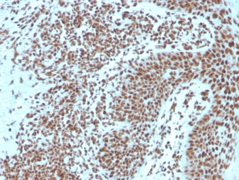 IHC staining of FFPE human basal cell carcinoma with Nucleophosmin antibody. HIER: boil tissue sections in pH6, 10mM citrate buffer, for 10-20 min and allow to cool before testing.~