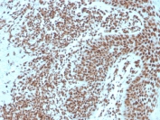 IHC staining of FFPE human basal cell carcinoma with Nucleophosmin antibody. HIER: boil tissue sections in pH6, 10mM citrate buffer, for 10-20 min and allow to cool before testing.