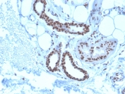 IHC staining of FFPE human basal cell carcinoma with Nucleophosmin antibody (clone NPM1/3285). HIER: boil tissue sections in pH6, 10mM citrate buffer, for 10-20 min and allow to cool before testing.
