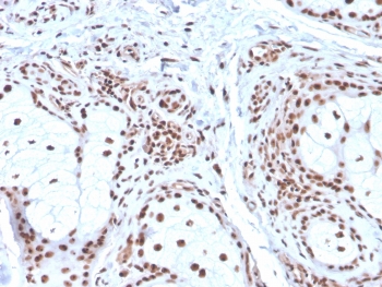 IHC staining of FFPE human basal cell carcinoma with Nucleophosmin antibody (clone NPM1/3286). HIER: boil tissue sections in pH 9 10mM Tris with 1mM EDTA for 10-20 min and allow to cool before testing.~