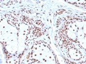 IHC staining of FFPE human basal cell carcinoma with Nucleophosmin antibody (clone NPM1/3286). HIER: boil tissue sections in pH 9 10mM Tris with 1mM EDTA for 10-20 min and allow to cool before testing.