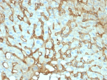 IHC testing of FFPE human hepatocellular carcinoma with human Albumin antibody (clone ALB/2141). Required HIER: boil tissue sections in 10mM citrate buffer, pH6, for 10-20 min followed by cooling at RT for 20 min.~