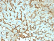 IHC testing of FFPE human hepatocellular carcinoma with human Albumin antibody (clone ALB/2141). Required HIER: boil tissue sections in 10mM citrate buffer, pH6, for 10-20 min followed by cooling at RT for 20 min.