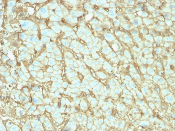 IHC testing of FFPE human hepatocellular carcinoma with human Albumin antibody (clone ALB/2142). Required HIER: boil tissue sections in 10mM citrate buffer, pH6, for 10-20 min followed by cooling at RT for 20 min.~