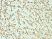 IHC testing of FFPE human hepatocellular carcinoma with human Albumin antibody (clone ALB/2142). Required HIER: boil tissue sections in 10mM citrate buffer, pH6, for 10-20 min followed by cooling at RT for 20 min.