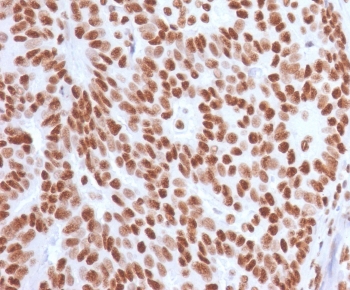 IHC staining of FFPE human breast carcinoma with Estrogen Receptor alpha antibody (clone NR3Ga-4). HIER: boil tissue sections in pH 9 10mM Tris with 1mM EDTA for 10-20 min and allow to cool before testing.~