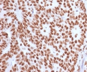 IHC staining of FFPE human breast carcinoma with Estrogen Receptor alpha antibody (clone NR3Ga-4). HIER: boil tissue sections in pH 9 10mM Tris with 1mM EDTA for 10-20 min and allow to cool before testing.
