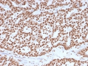 IHC staining of FFPE human breast carcinoma with Estrogen Receptor alpha antibody (clone ESR1/3557). HIER: boil tissue sections in pH 9 10mM Tris with 1mM EDTA for 10-20 min and allow to cool before testing.
