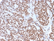 IHC staining of FFPE human breast carcinoma with Estrogen Receptor alpha antibody (clone ESR1/3557). HIER: boil tissue sections in pH 9 10mM Tris with 1mM EDTA for 10-20 min and allow to cool before testing.