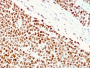 IHC staining of FFPE human small intestine with MSH6 antibody (clone MSH6/3086). HIER: boil tissue sections in pH 9 10mM Tris with 1mM EDTA for 10-20 min and allow to cool before testing.