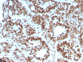 IHC staining of FFPE human colon carcinoma with MSH6 antibody (clone MSH6/3086). HIER: boil tissue sections in pH 9 10mM Tris with 1mM EDTA for 10-20 min and allow to cool before testing.
