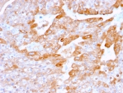 IHC staining of FFPE human renal cell carcinoma with CD137 antibody (clone 4-1BB/3201). HIER: boil tissue sections in pH9 10mM Tris with 1mM EDTA for 10-20 min and allow to cool before testing.