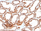 IHC staining of FFPE human renal cell carcinoma with biotinylated CD137 antibody (clone 4-1BB/3201). HIER: boil tissue sections in pH9 10mM Tris with 1mM EDTA for 10-20 min and allow to cool before testing.
