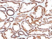 IHC staining of FFPE human renal cell carcinoma with biotinylated CD137 antibody (clone 4-1BB/3201). HIER: boil tissue sections in pH9 10mM Tris with 1mM EDTA for 10-20 min and allow to cool before testing.