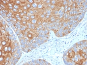 IHC staining of FFPE human cervical carcinoma with Cytokeratin 5 antibody (clone KRT5/3594). HIER: boil tissue sections in pH6, 10mM citrate buffer, for 10-20 min and allow to cool before testing.