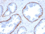 IHC staining of FFPE human prostate carcinoma with Cytokeratin 5 antibody (clone KRT5/3594). HIER: boil tissue sections in pH6, 10mM citrate buffer, for 10-20 min and allow to cool before testing.