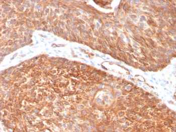 IHC staining of FFPE human pancreas with Cytokeratin 5 antibody (clone KRT5/3594). HIER: boil tissue sections in pH6, 10mM citrate buffer, for 10-20 min and allow to cool before testing.