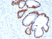 IHC staining of FFPE human prostate carcinoma with Cytokeratin 5 antibody (clone KRT5/3594). HIER: boil tissue sections in pH6, 10mM citrate buffer, for 10-20 min and allow to cool before testing.