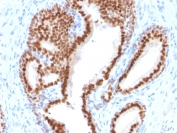 IHC staining of FFPE human prostate carcinoma with NKX3.1 antibody (clone NKX3.1/2576). HIER: boil tissue sections in pH6, 10mM citrate buffer, for 10-20 min and allow to cool before testing.